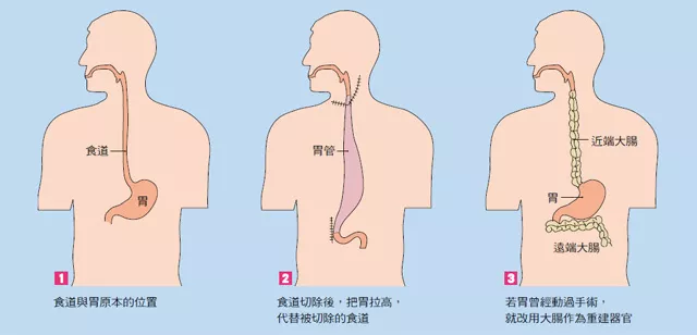 龙陵县人民医院独立开展县域首例胸腹腔镜联合食管癌根治术